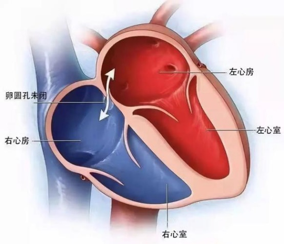 Kaiyun网址 开云合作共赢！唯柯医疗D-shufo™新一代卵圆孔未闭封堵器启动招商